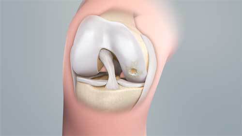 Cartilage Repair/Regeneration Market